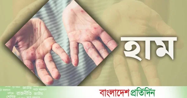হামে প্রাপ্তবয়স্করাও আক্রান্ত হচ্ছে কেন? | | বাংলাদেশ প্রতিদিন