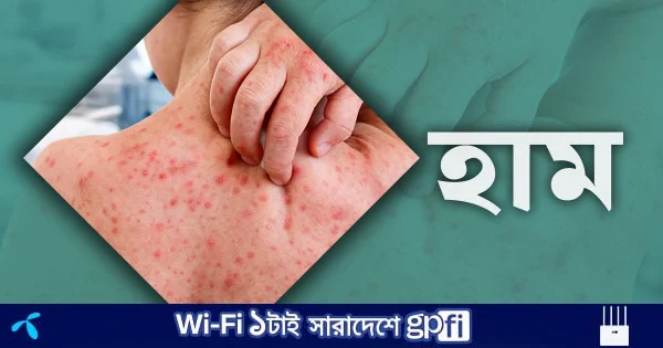 ফরিদপুরে হাম উপসর্গে আরও ২ শিশুর মৃত্যু | | বাংলাদেশ প্রতিদিন