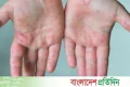 হামে বরিশাল বিভাগে মৃত বেড়ে ৫১ | | বাংলাদেশ প্রতিদিন